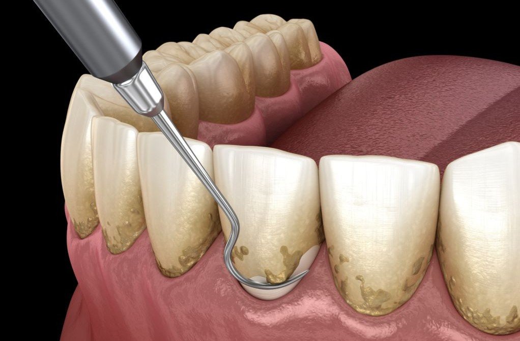 Ilustrasi karang gigi.